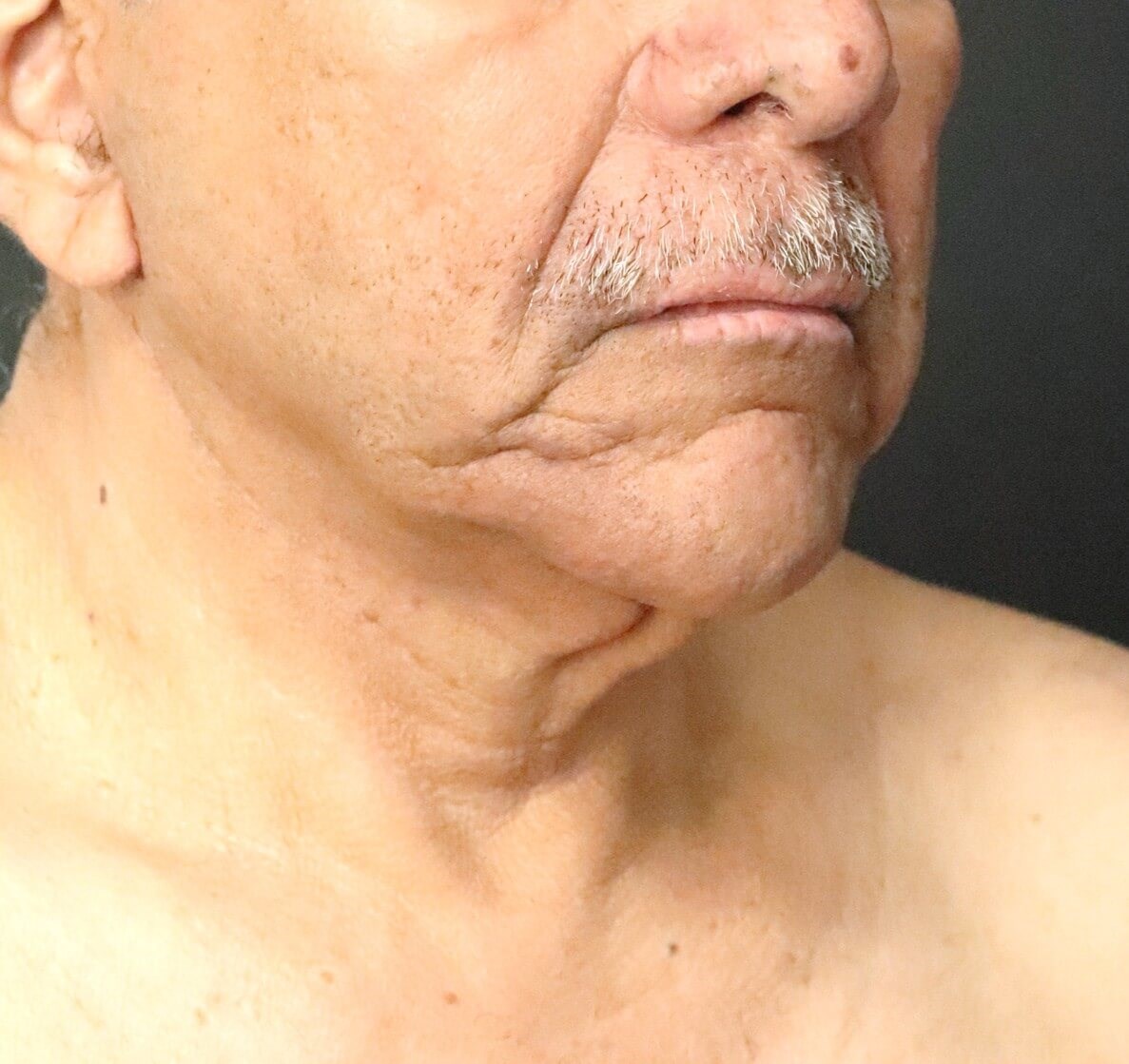 T to Z Direct Necklift in Male Before