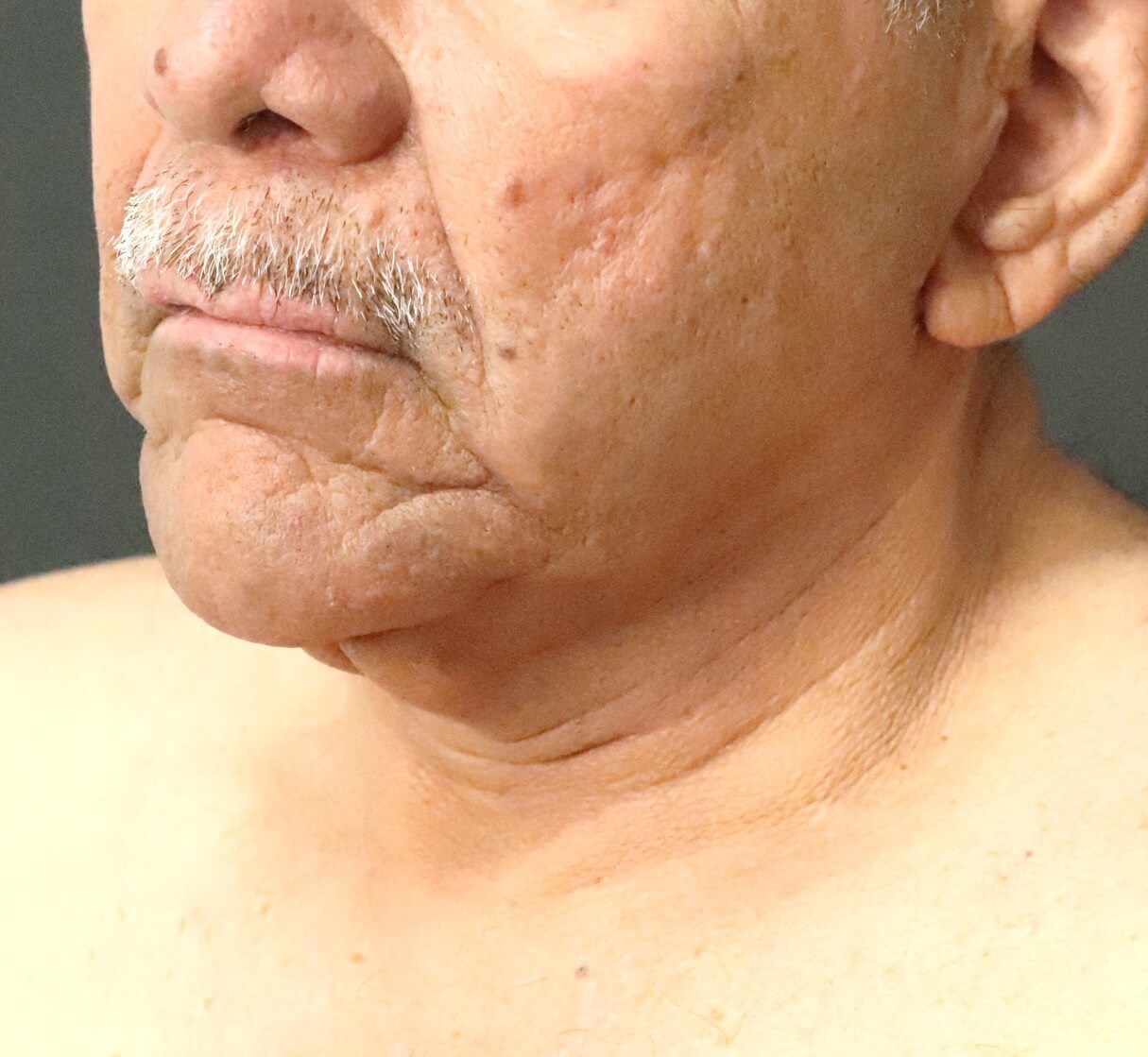 T to Z Direct Necklift in Male Before