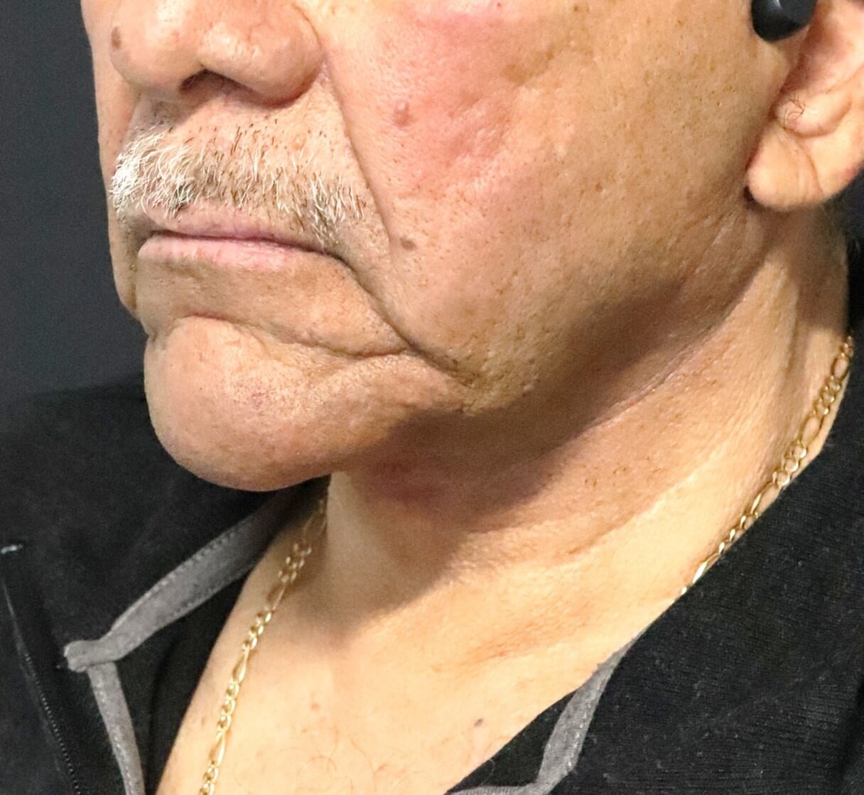 T to Z Direct Necklift in Male After