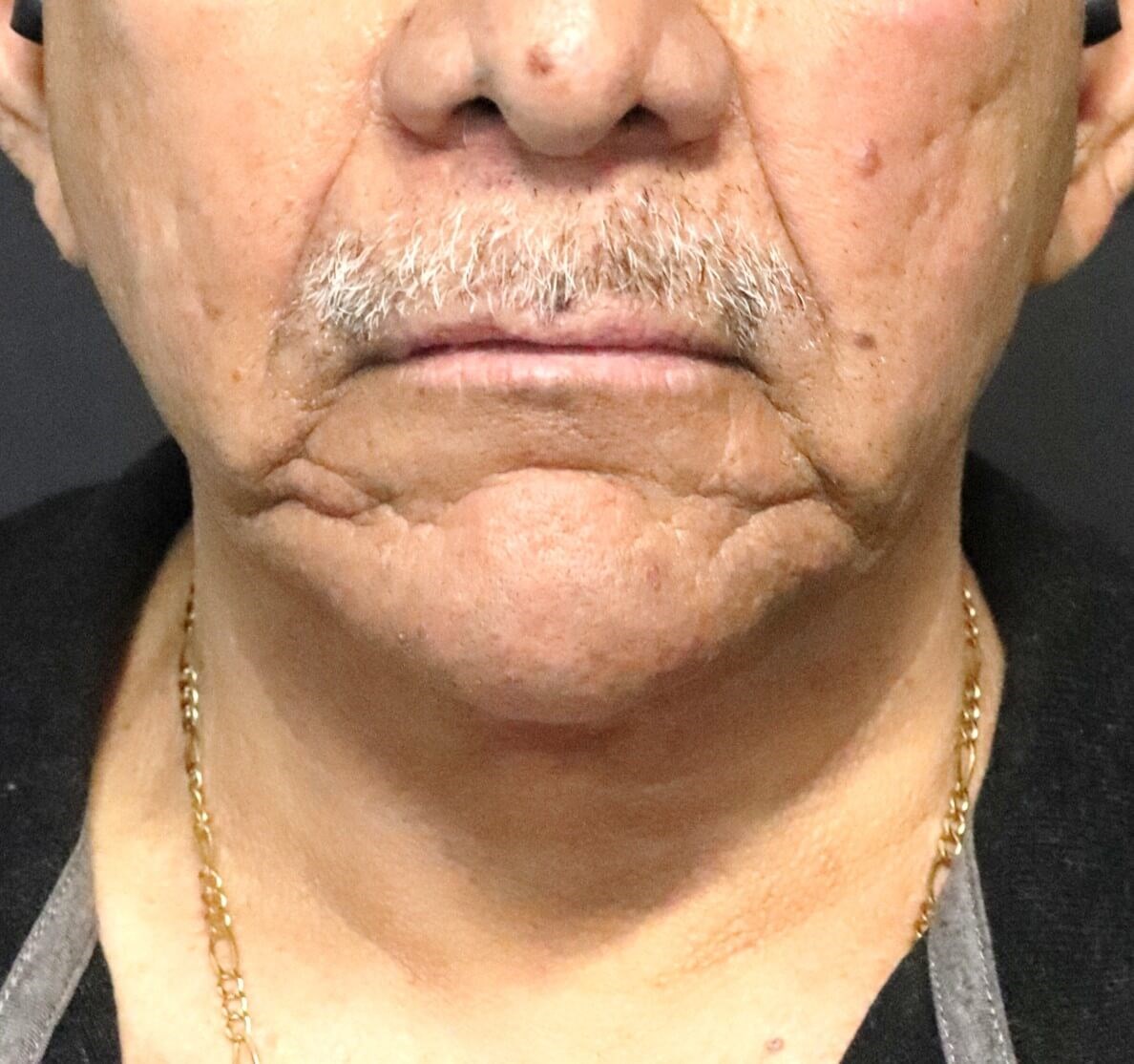 T to Z Direct Necklift in Male After
