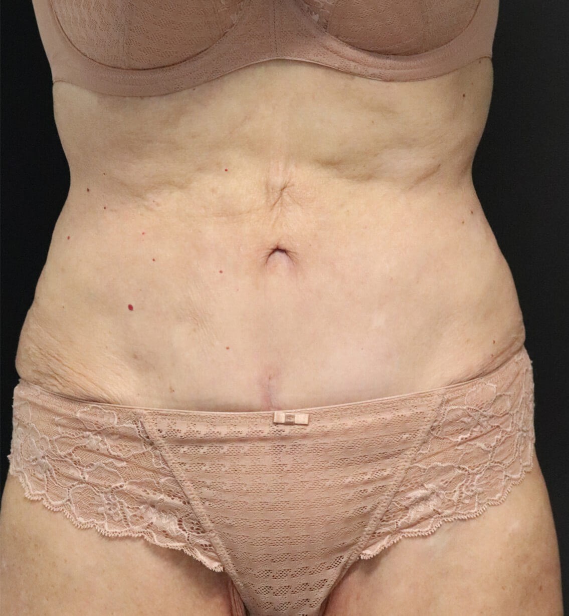 Tummy Tuck for 70+ After