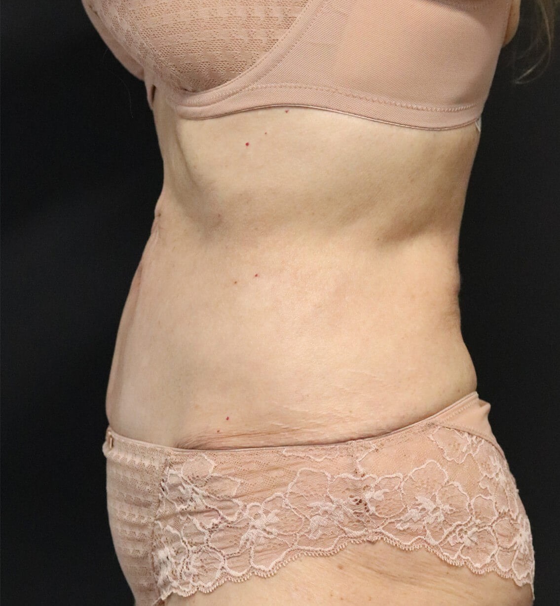 Tummy Tuck for 70+ After