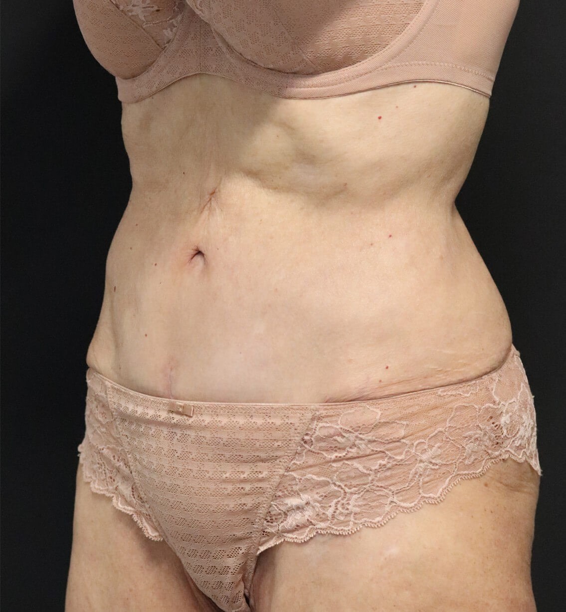 Tummy Tuck for 70+ After