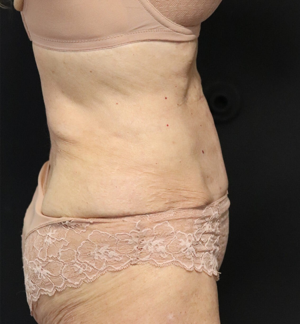 Tummy Tuck for 70+ After
