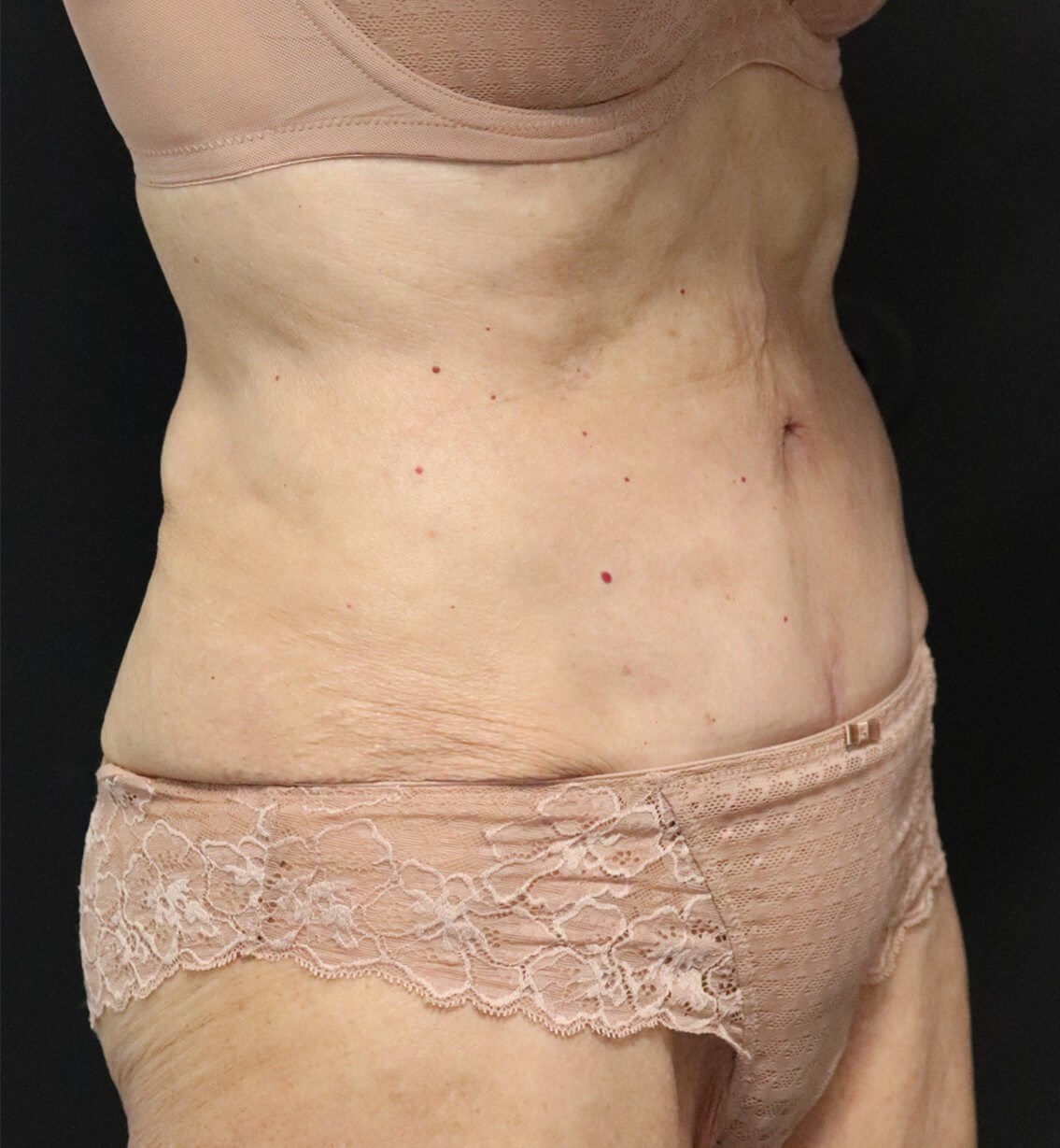 Tummy Tuck for 70+ After