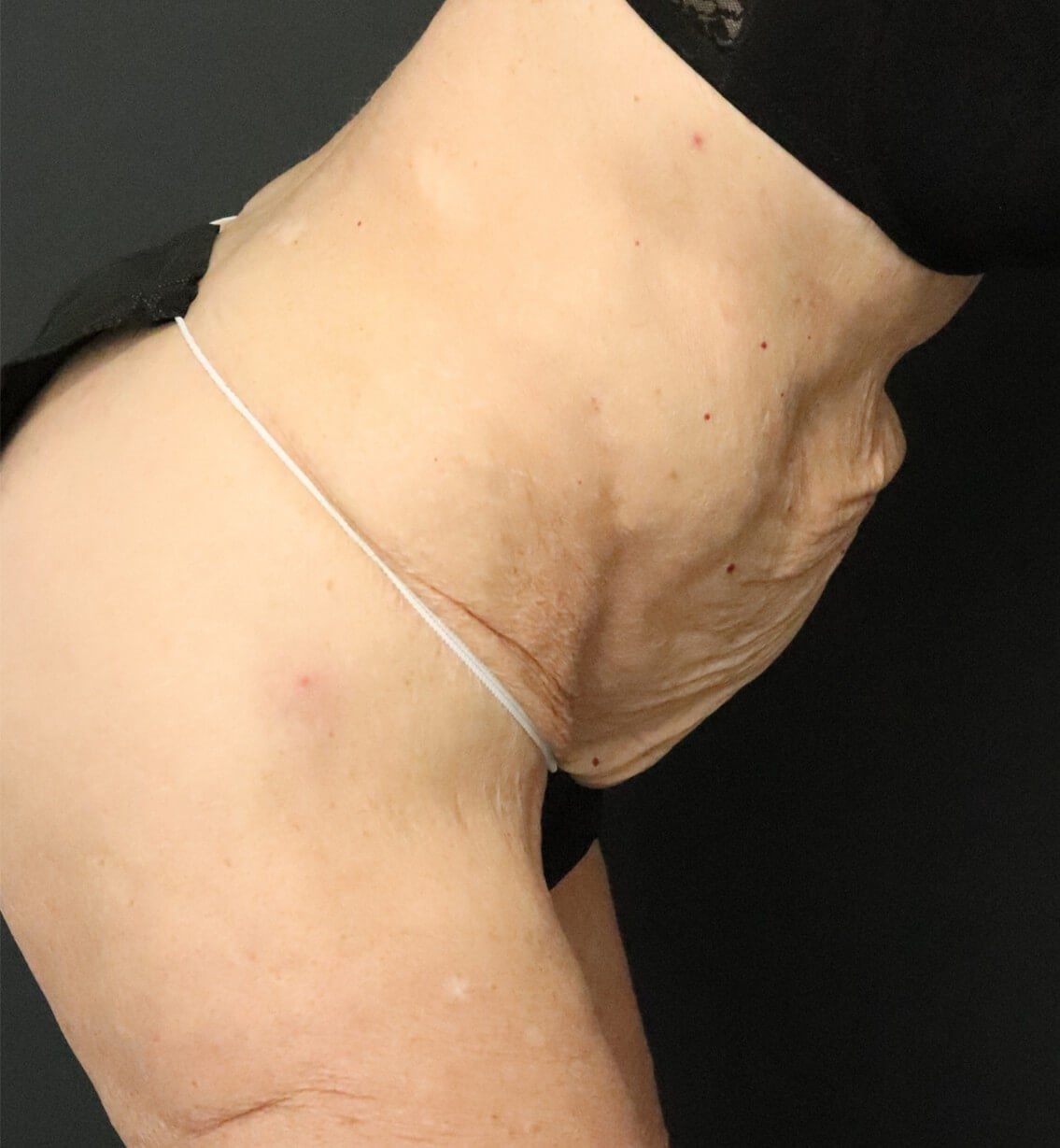 Tummy Tuck for 70+ Before