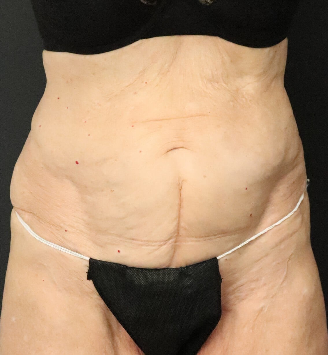 Tummy Tuck for 70+ Before