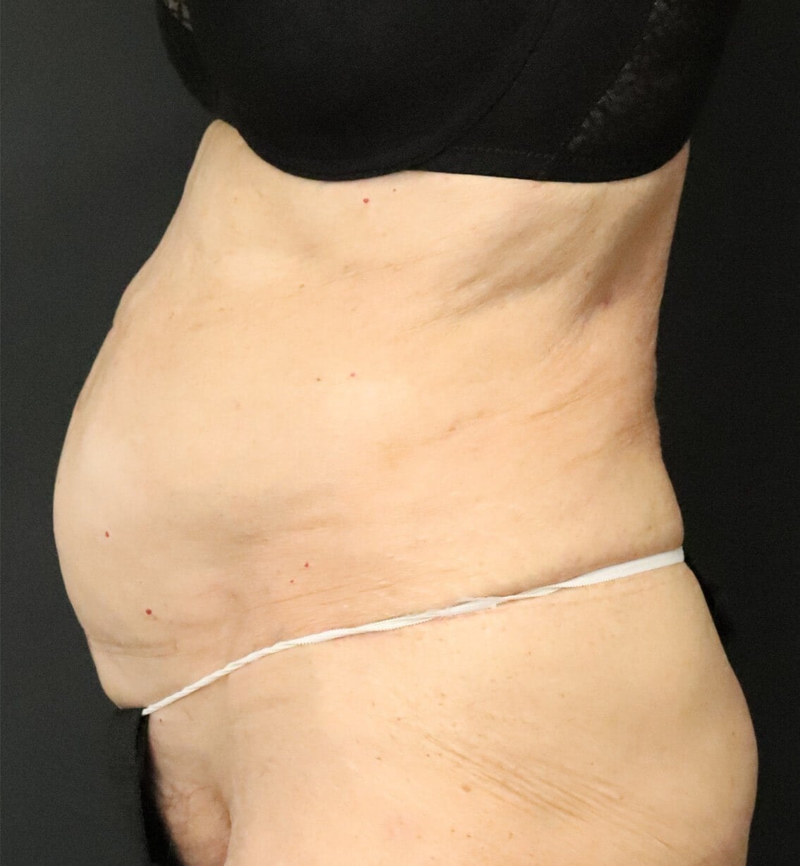 Tummy Tuck for 70+ Before