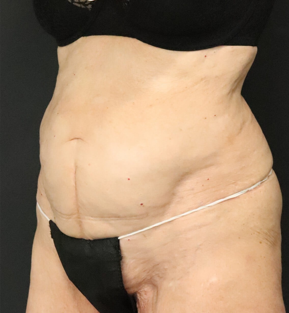 Tummy Tuck for 70+ Before