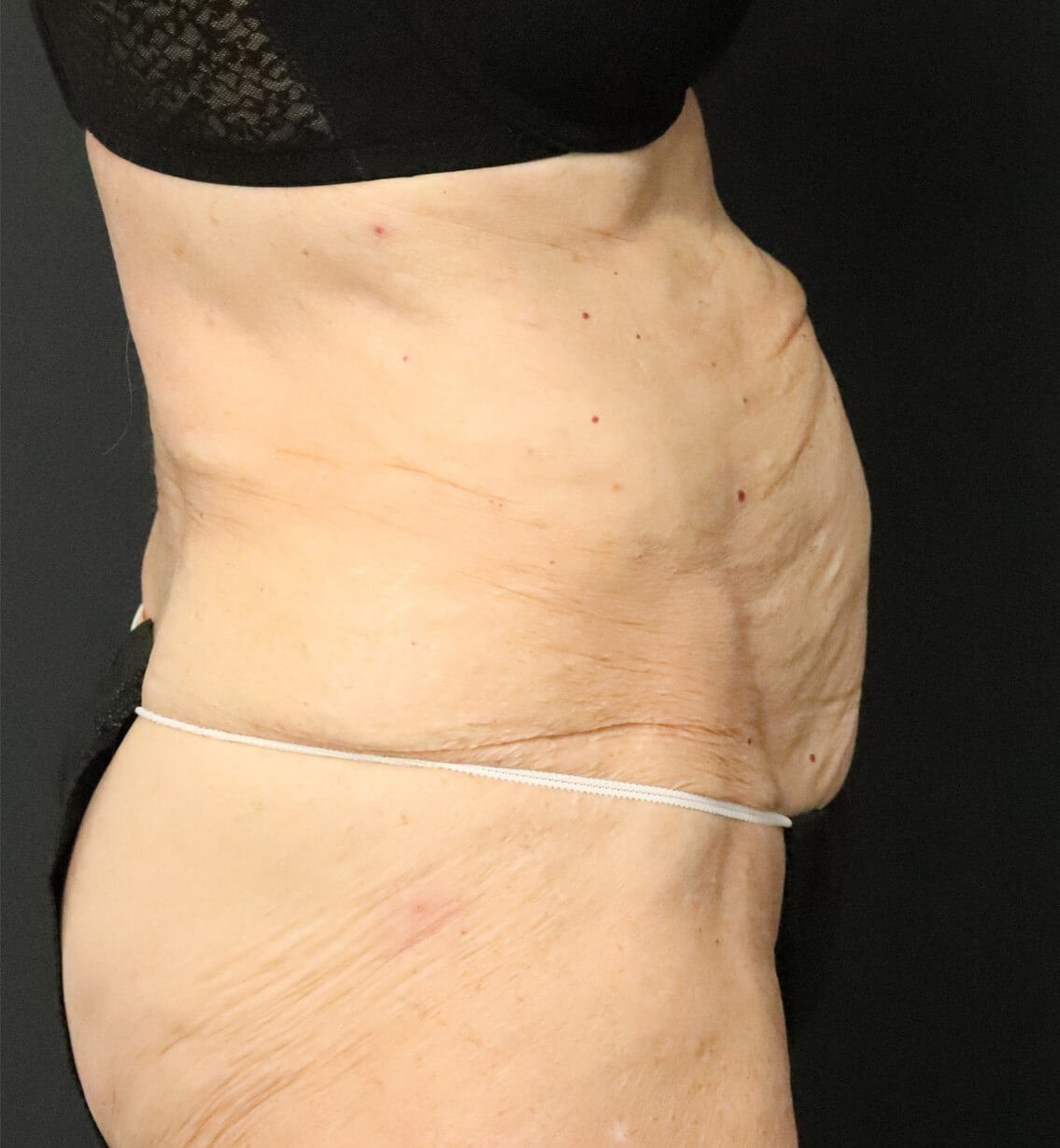 Tummy Tuck for 70+ Before