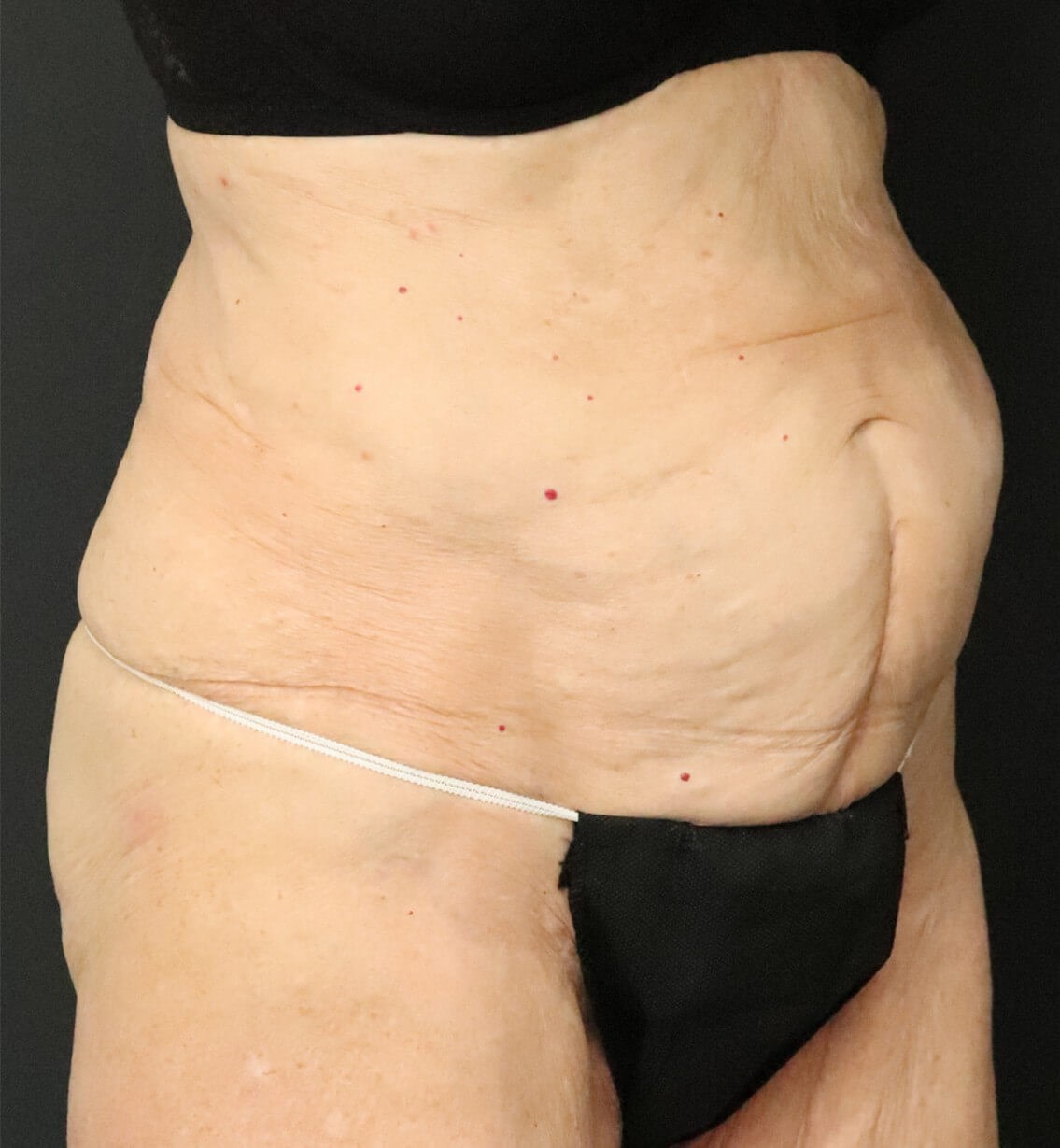 Tummy Tuck for 70+ Before
