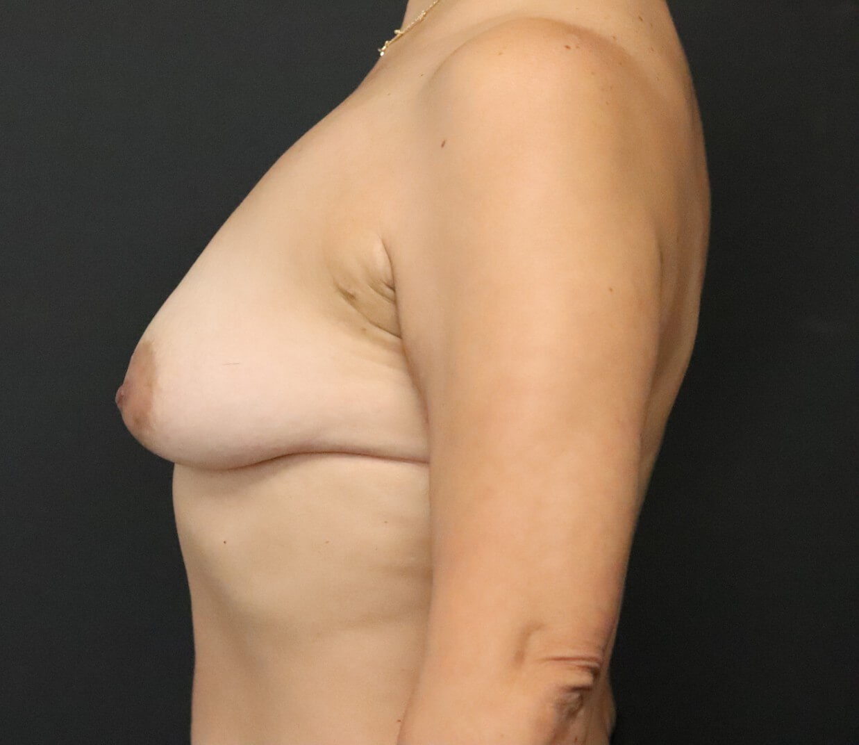 Motiva Breast Augmentation Before