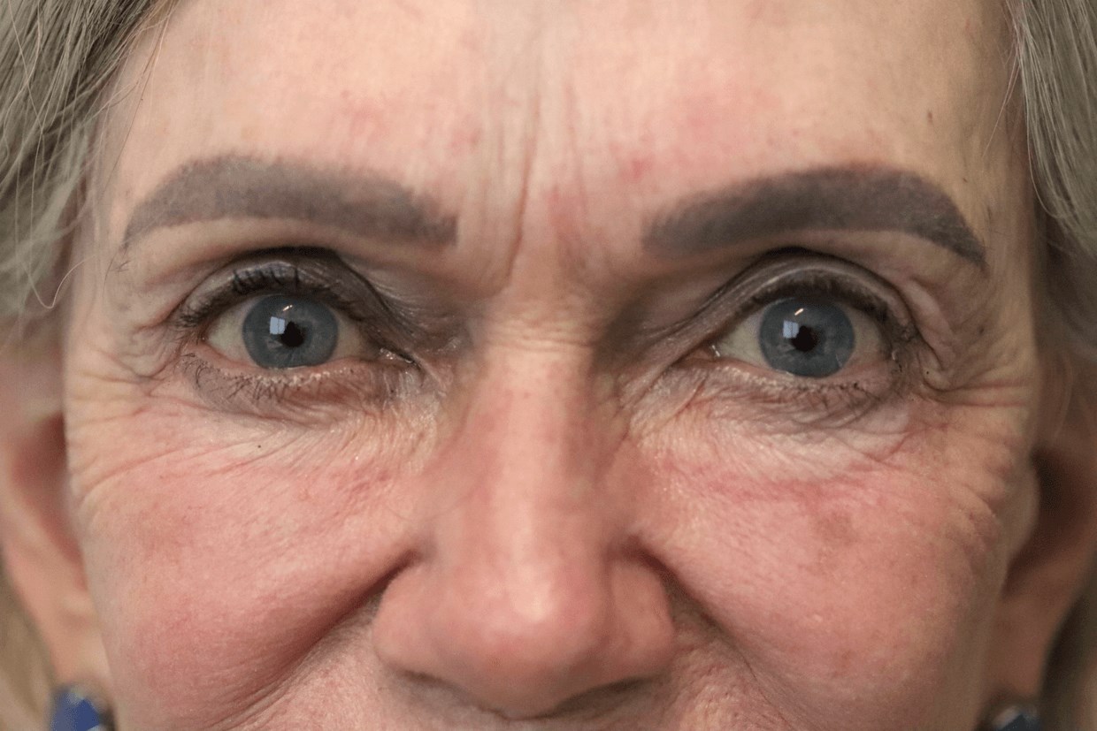 Ptosis Repair Under Local After