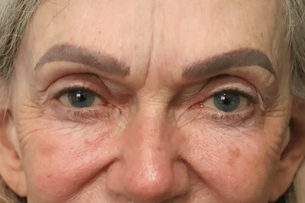 Ptosis Repair Under Local Before