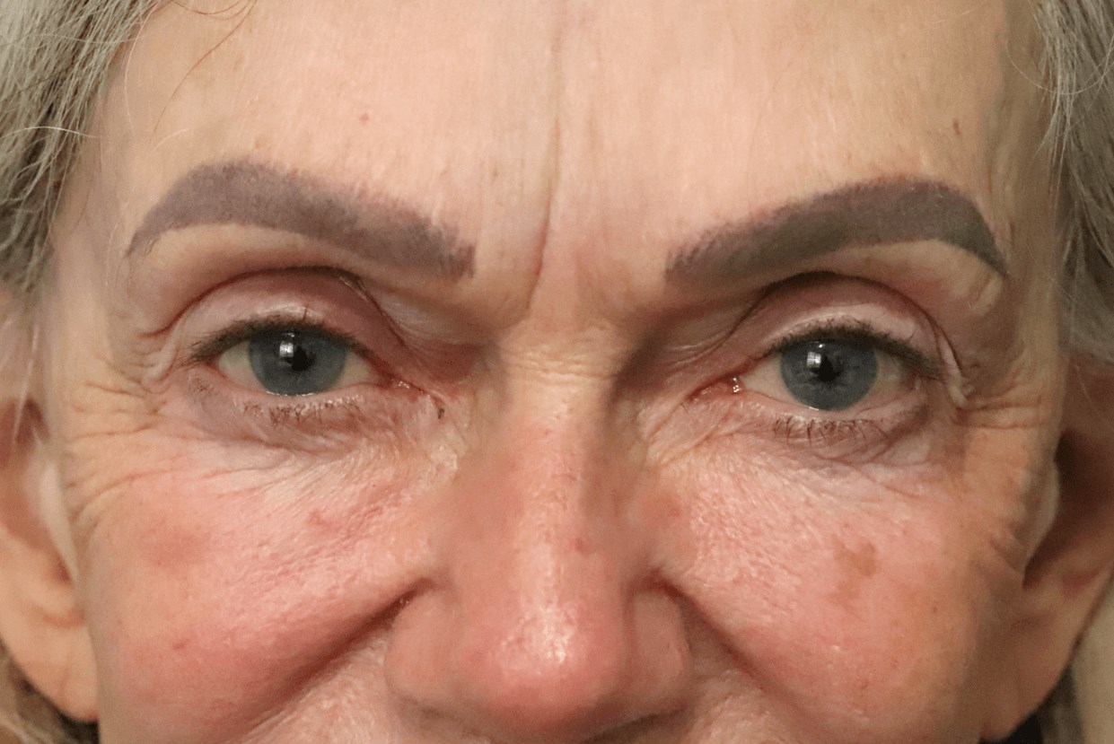 Ptosis Repair Under Local Before