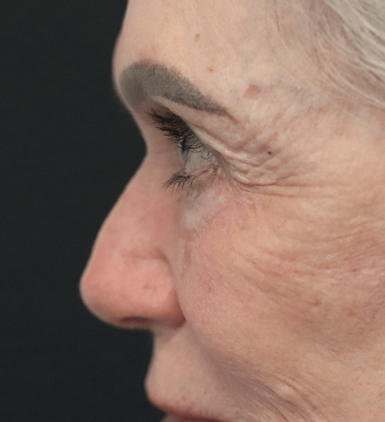 Ptosis Repair Under Local After