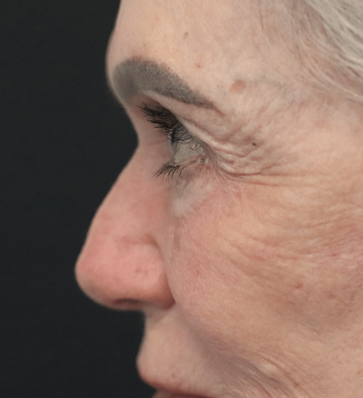 Ptosis Repair Under Local After