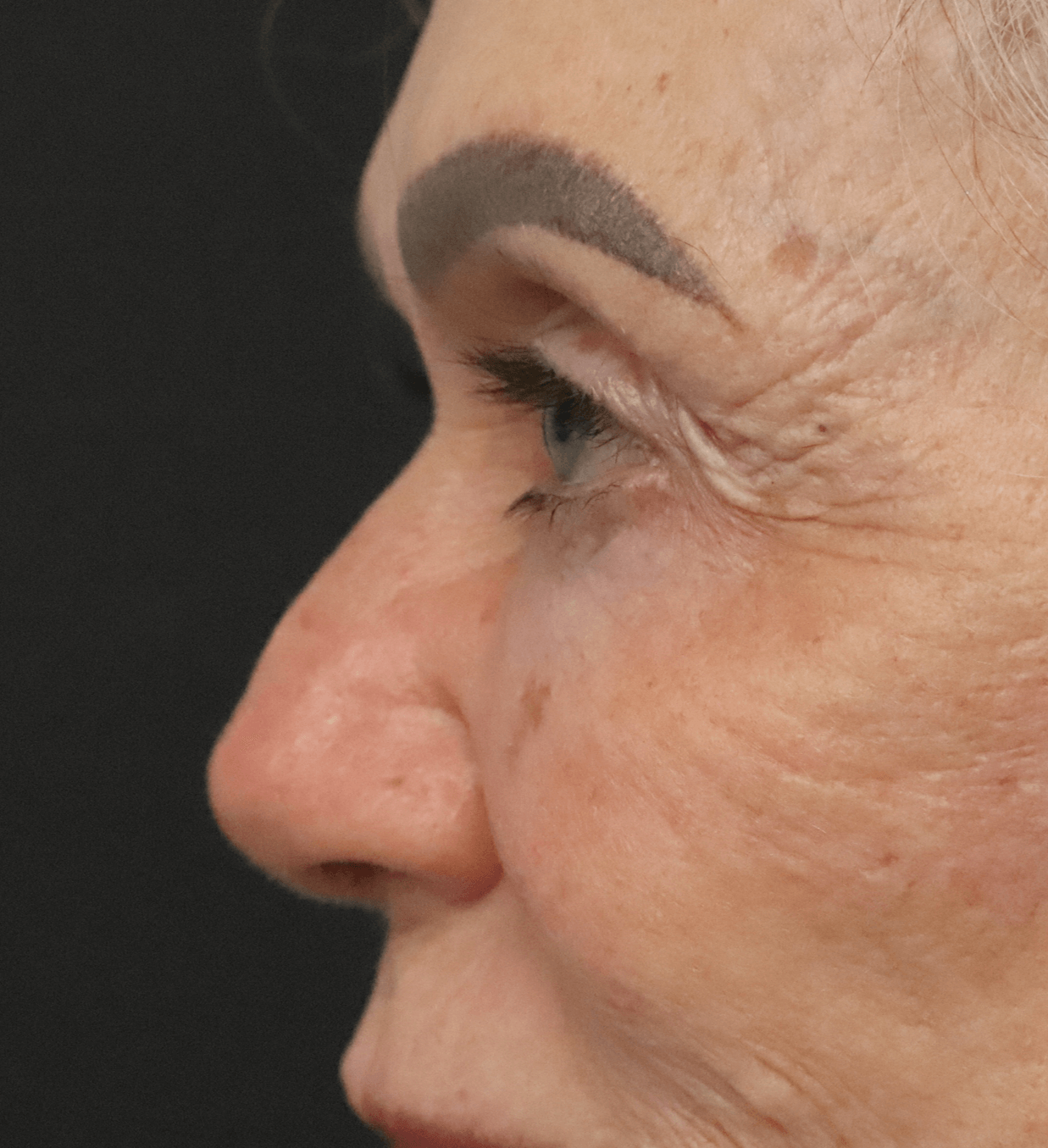 Ptosis Repair Under Local Before