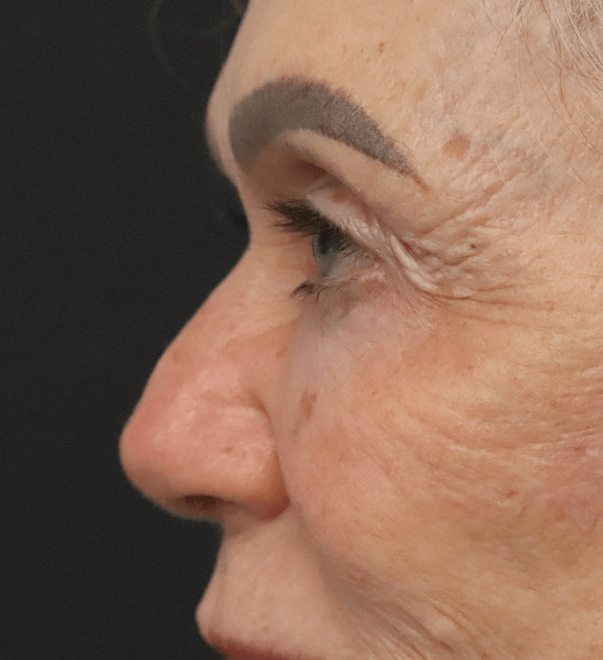 Ptosis Repair Under Local Before