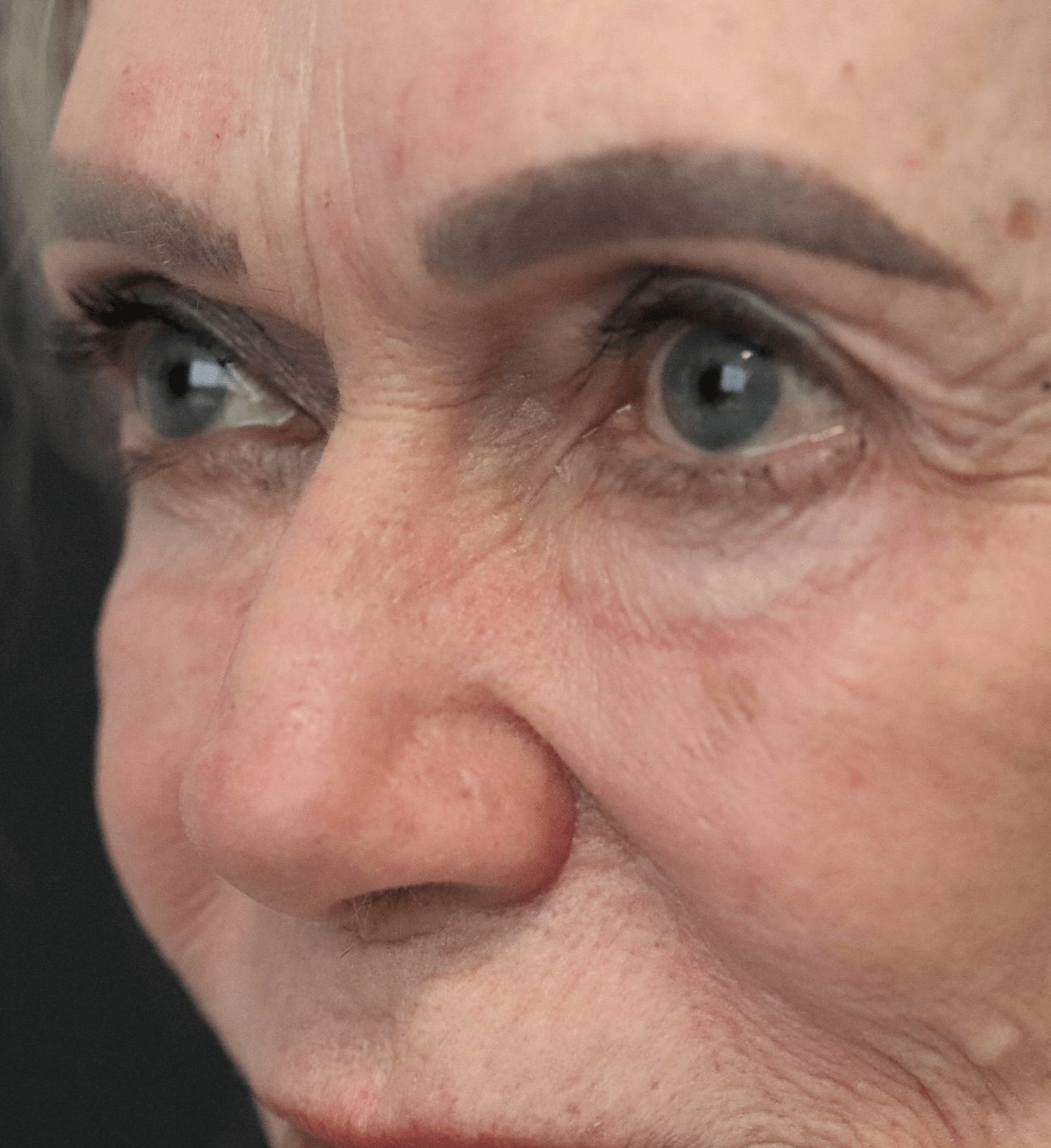 Ptosis Repair Under Local After