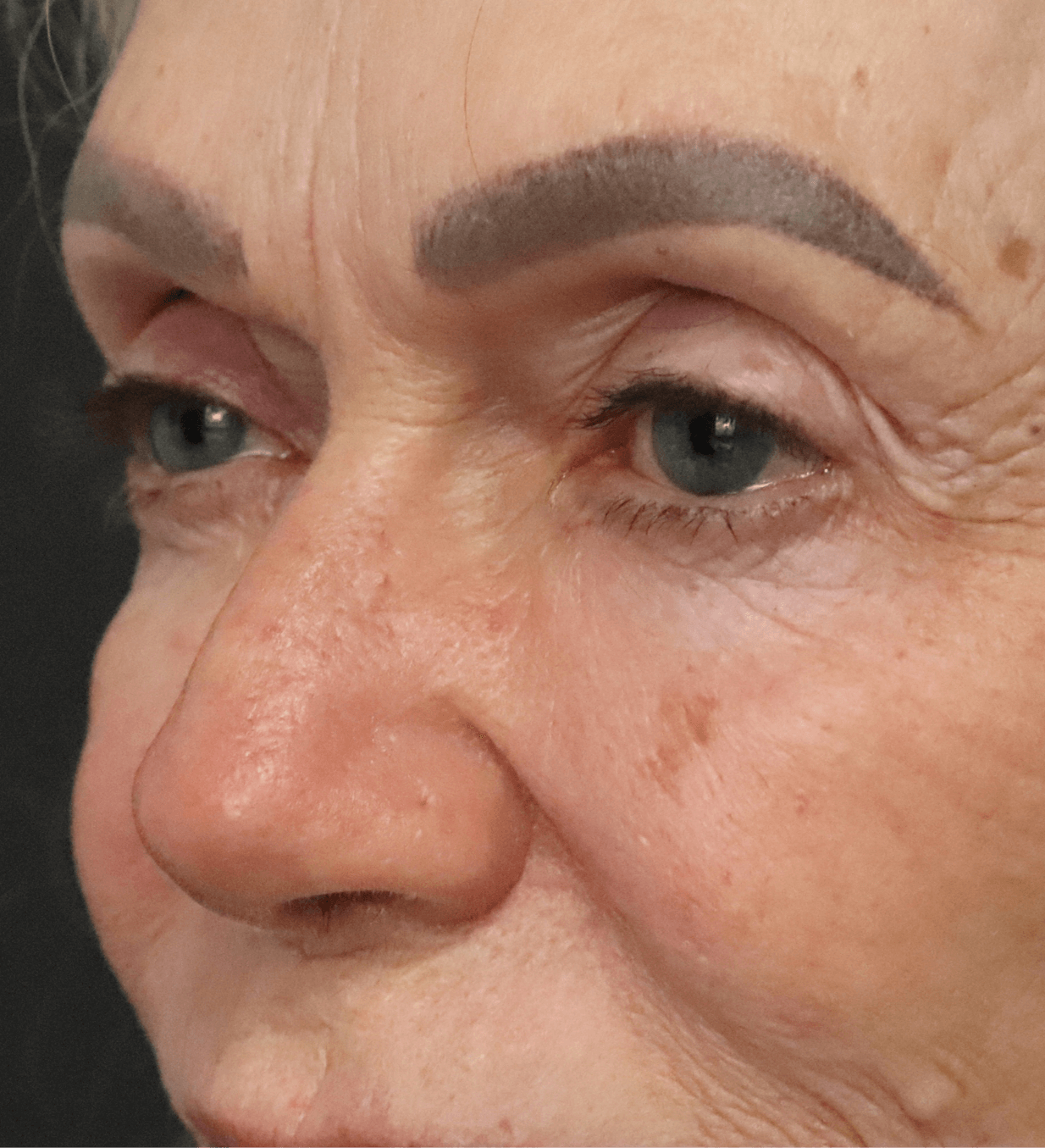 Ptosis Repair Under Local Before