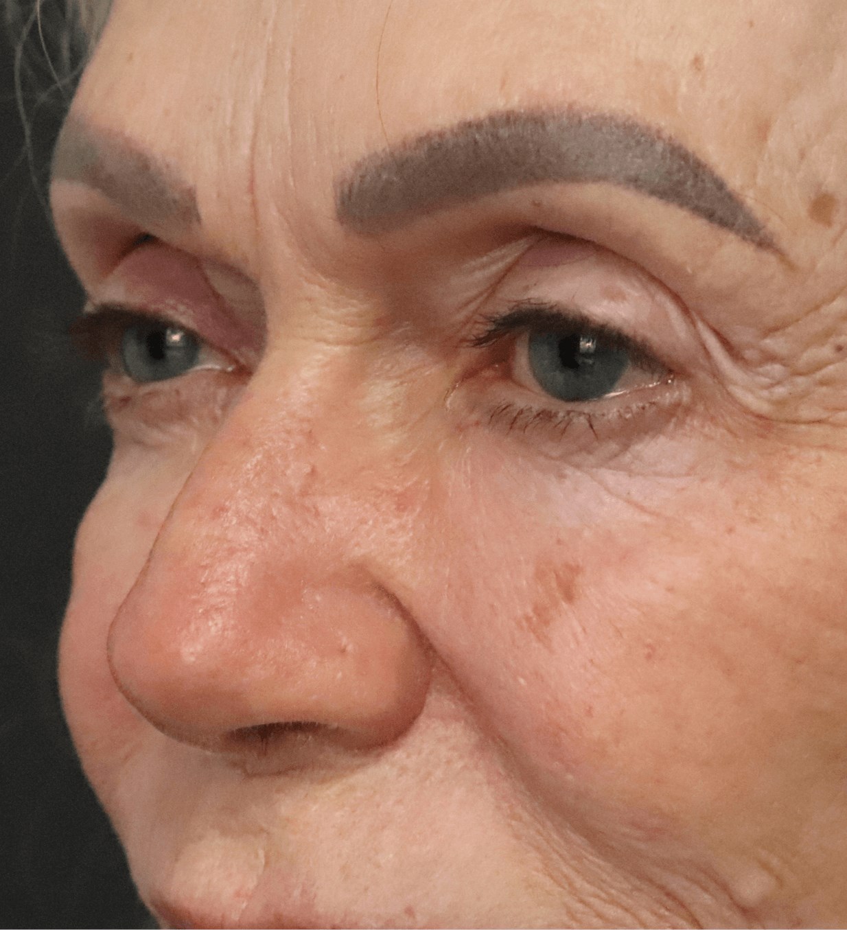 Ptosis Repair Under Local Before