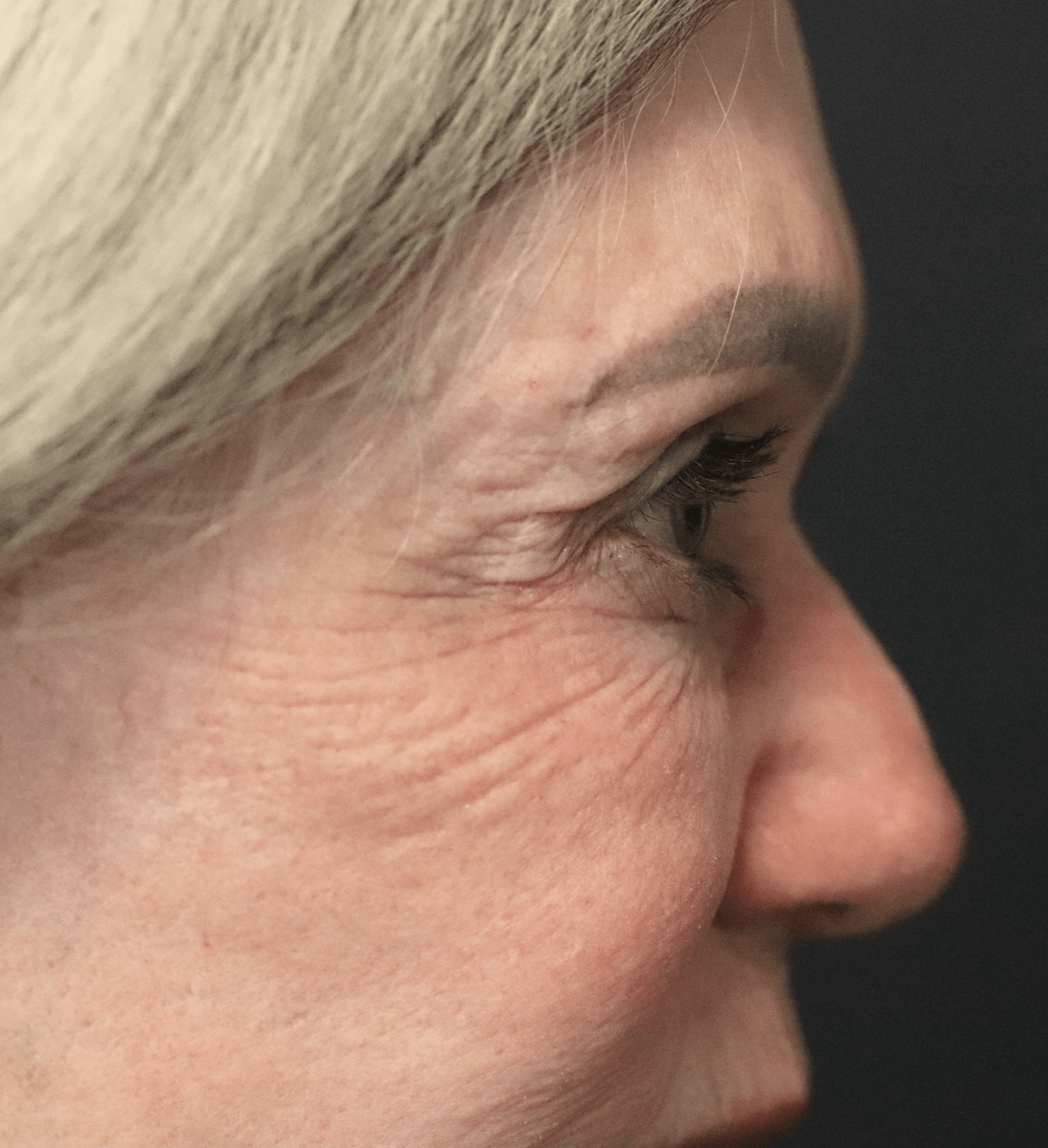 Ptosis Repair Under Local After