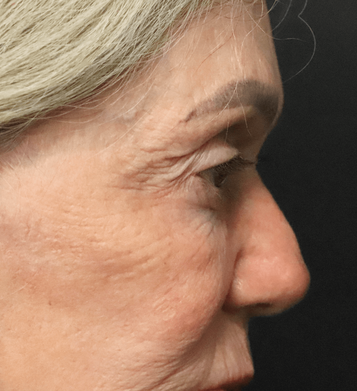 Ptosis Repair Under Local Before