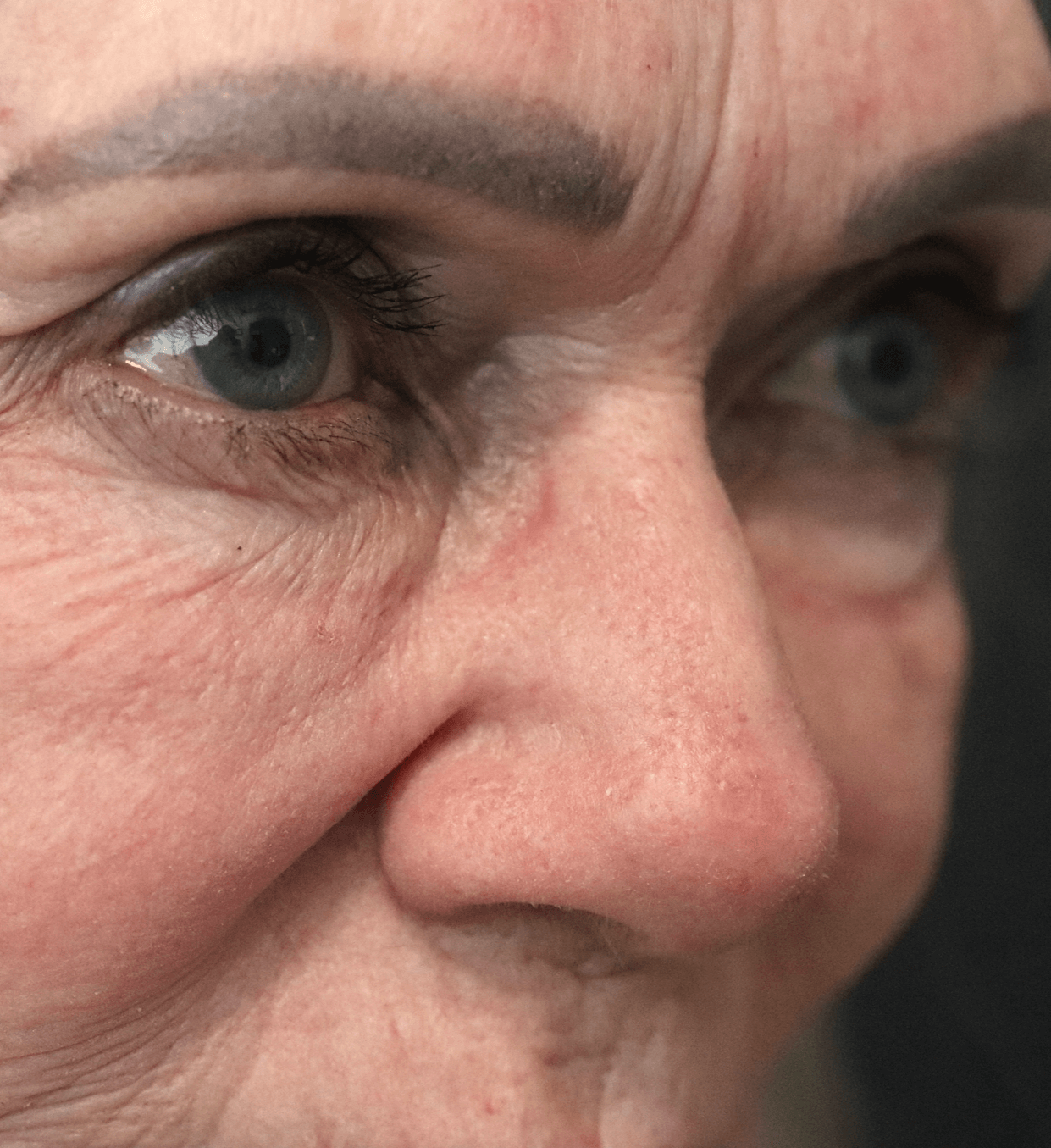Ptosis Repair Under Local After