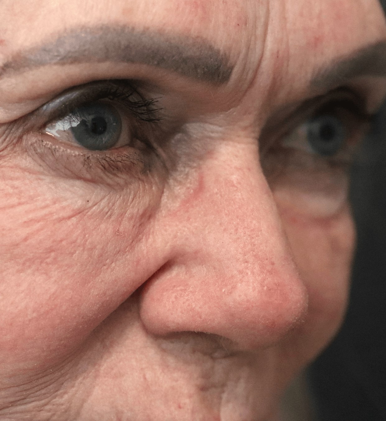Ptosis Repair Under Local After