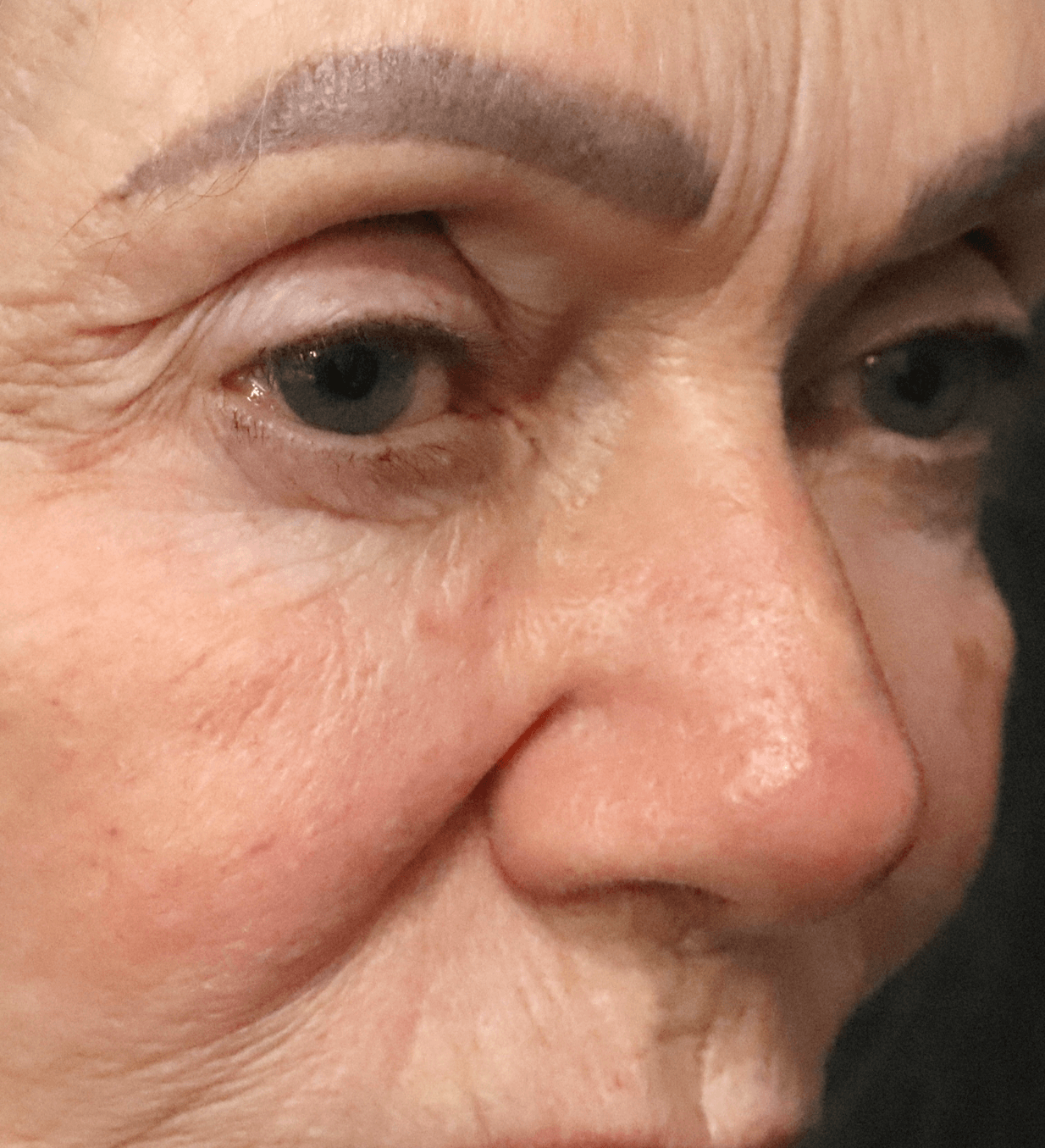 Ptosis Repair Under Local Before