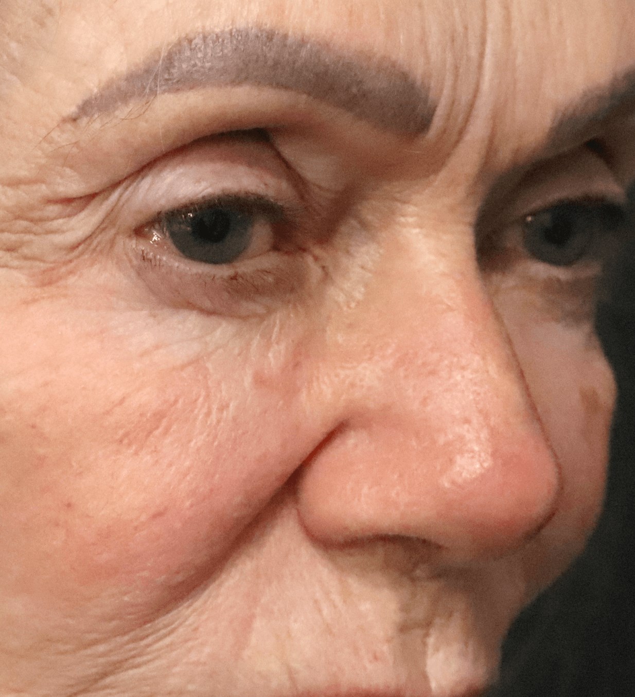 Ptosis Repair Under Local Before