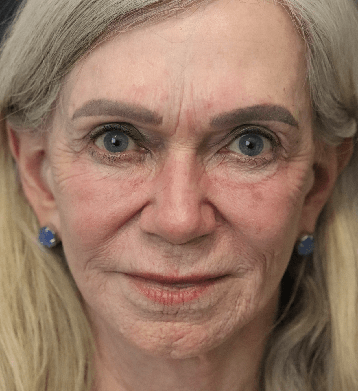 CO2 Laser Resurfacing After