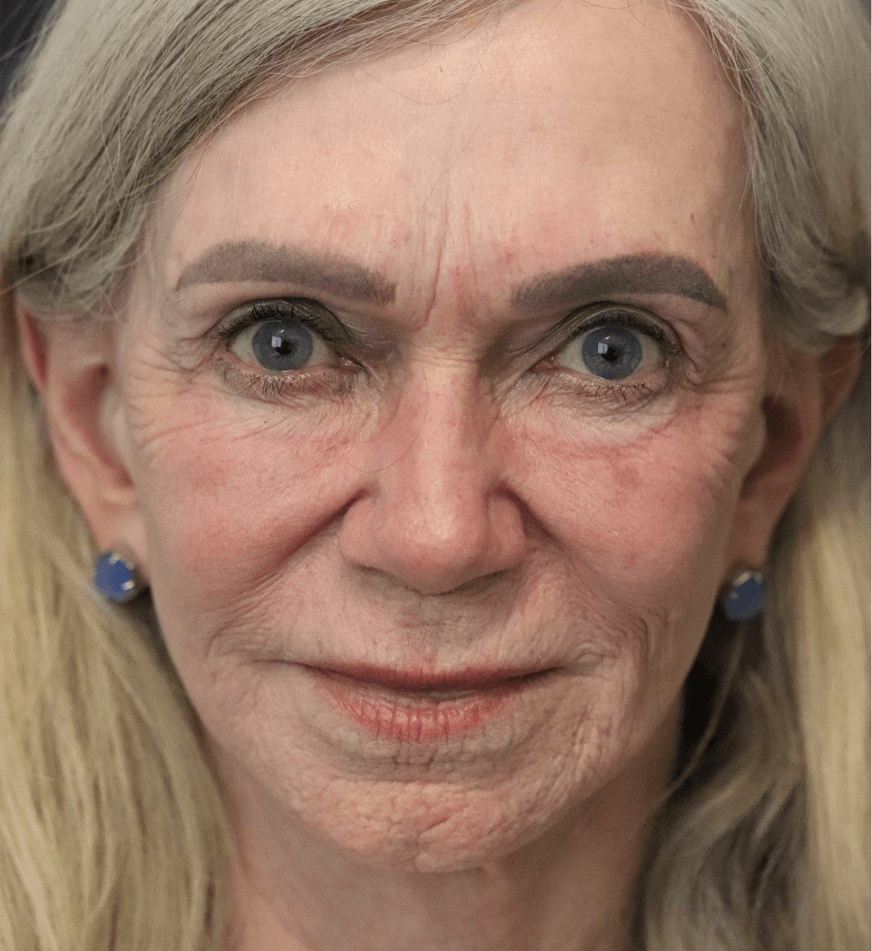 CO2 Laser Resurfacing After
