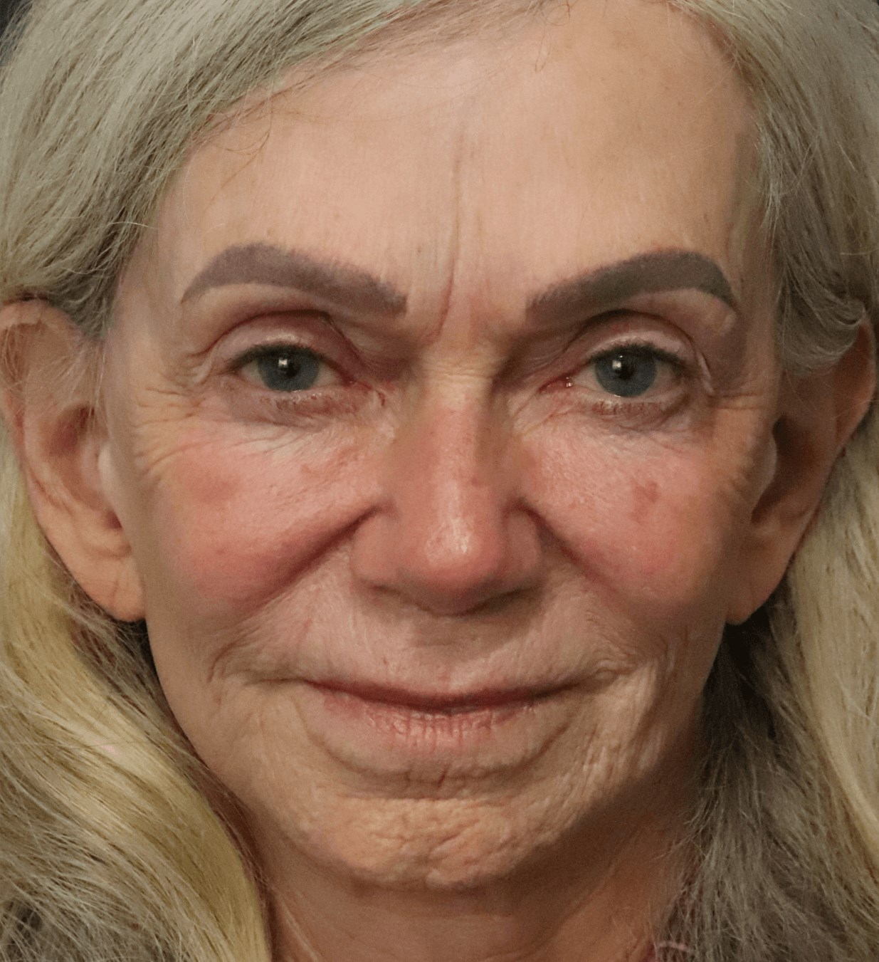 CO2 Laser Resurfacing Before