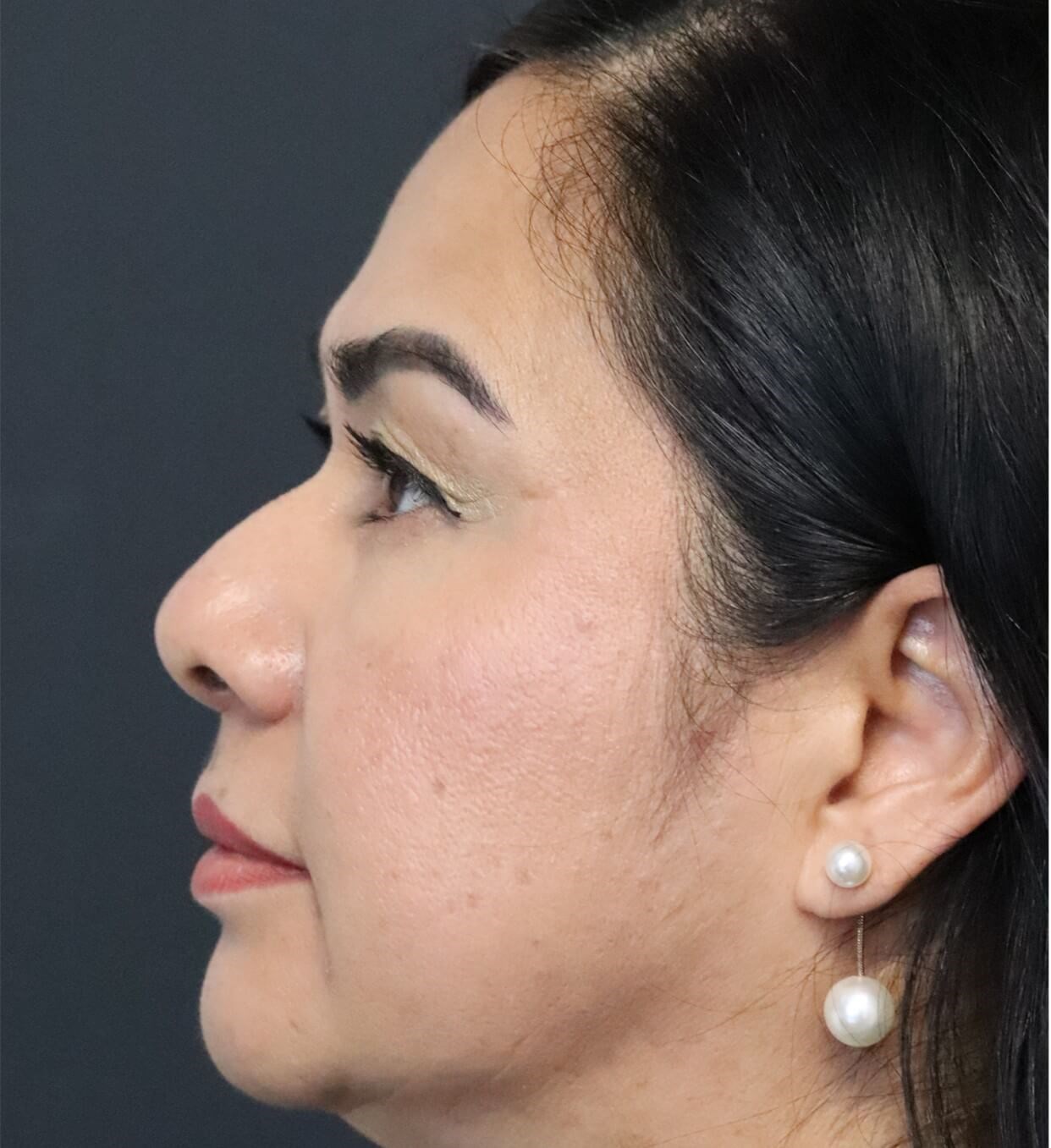 Lower Lid Blepharoplasty After