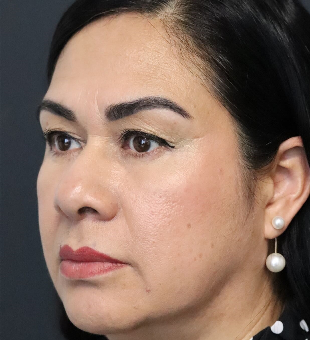 Lower Lid Blepharoplasty After