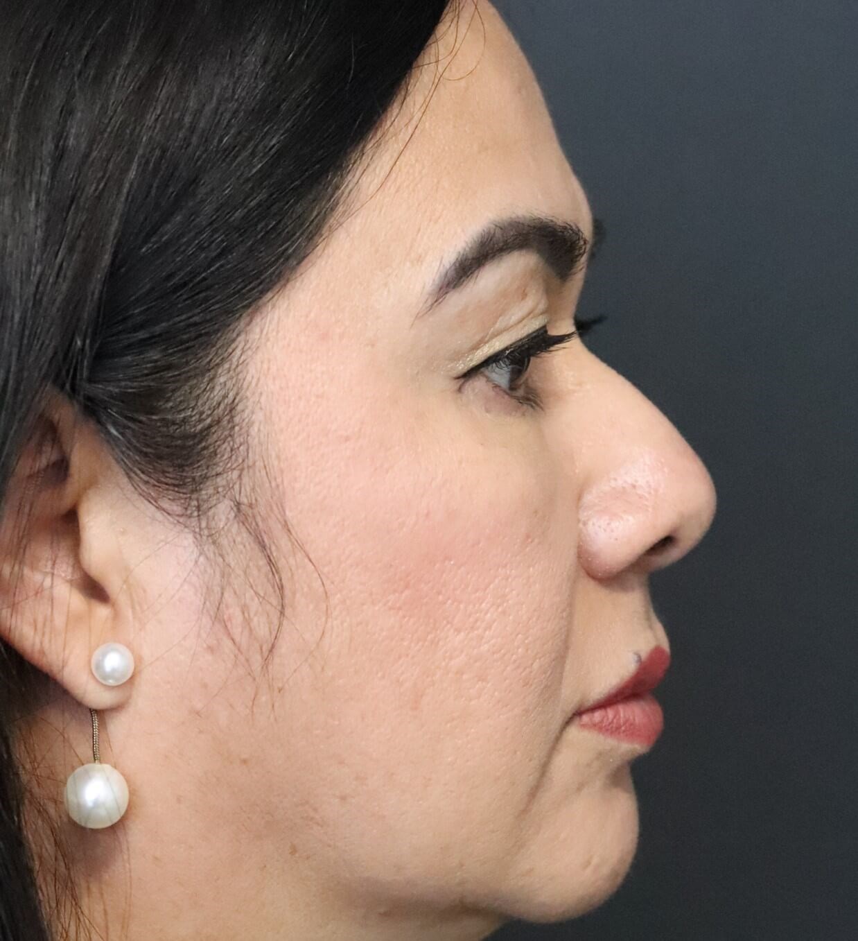 Lower Lid Blepharoplasty After