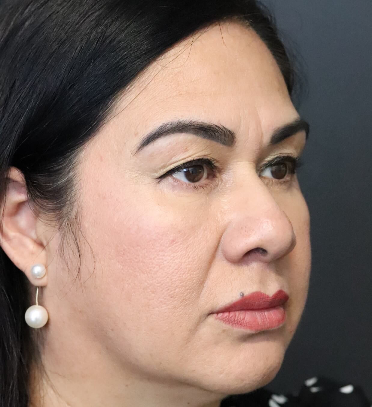 Lower Lid Blepharoplasty After