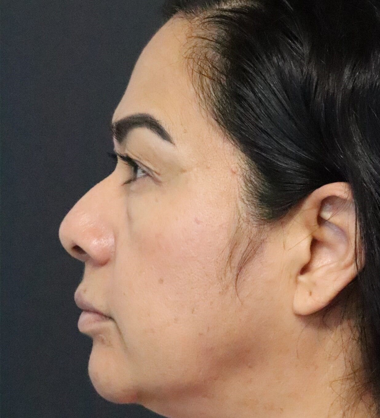 Lower Lid Blepharoplasty Before