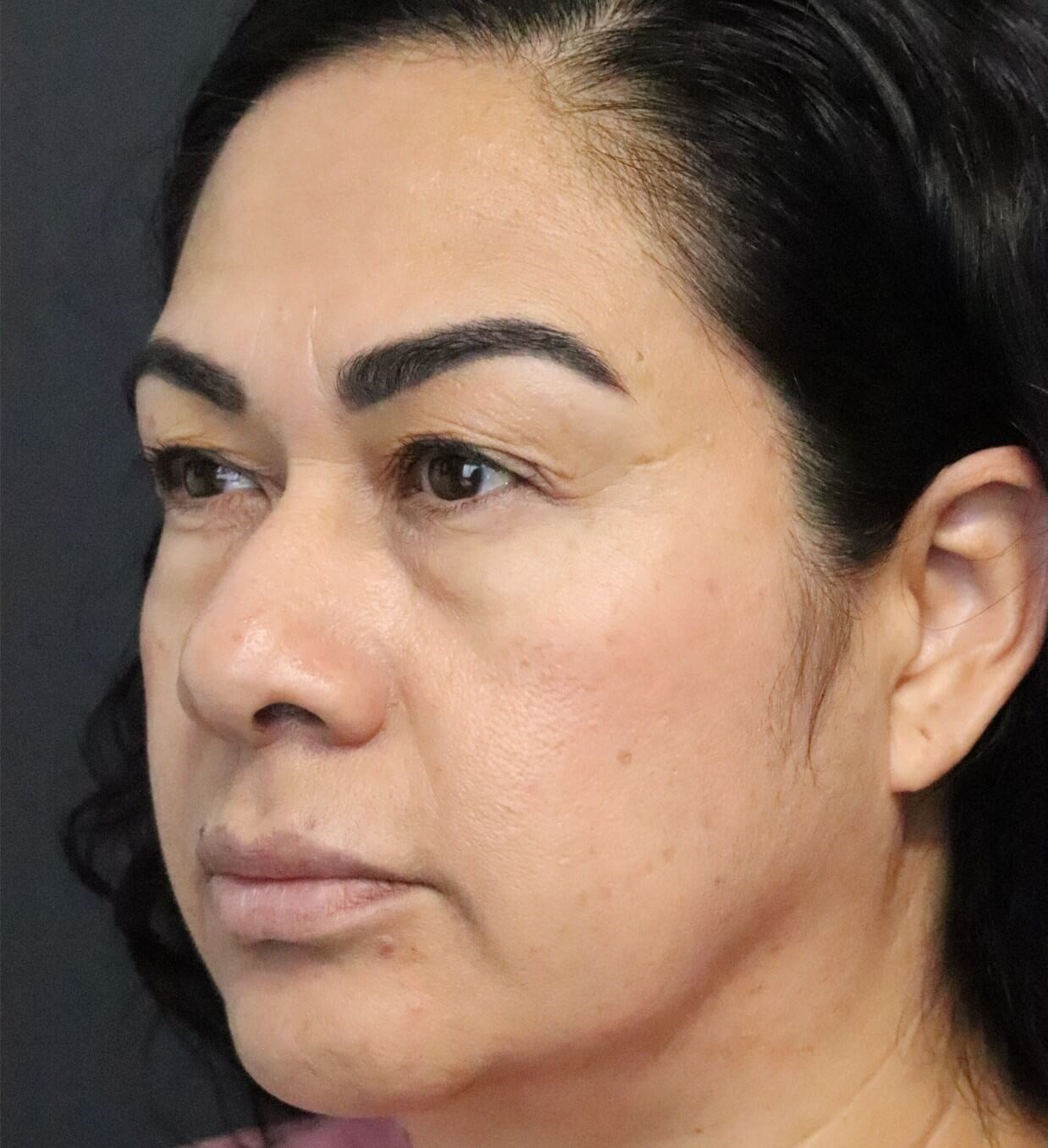 Lower Lid Blepharoplasty Before