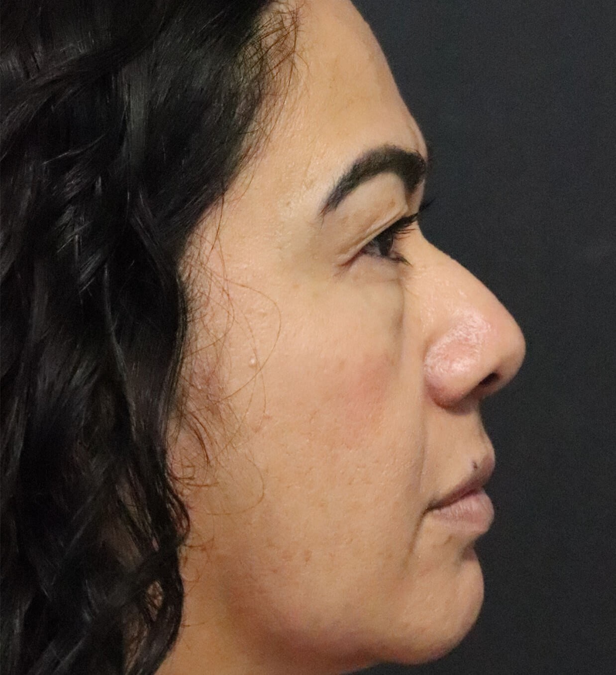Lower Lid Blepharoplasty Before