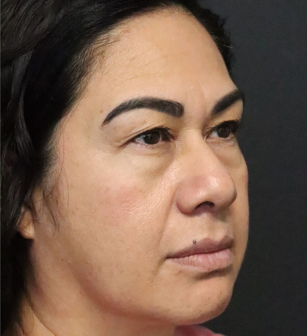 Lower Lid Blepharoplasty Before