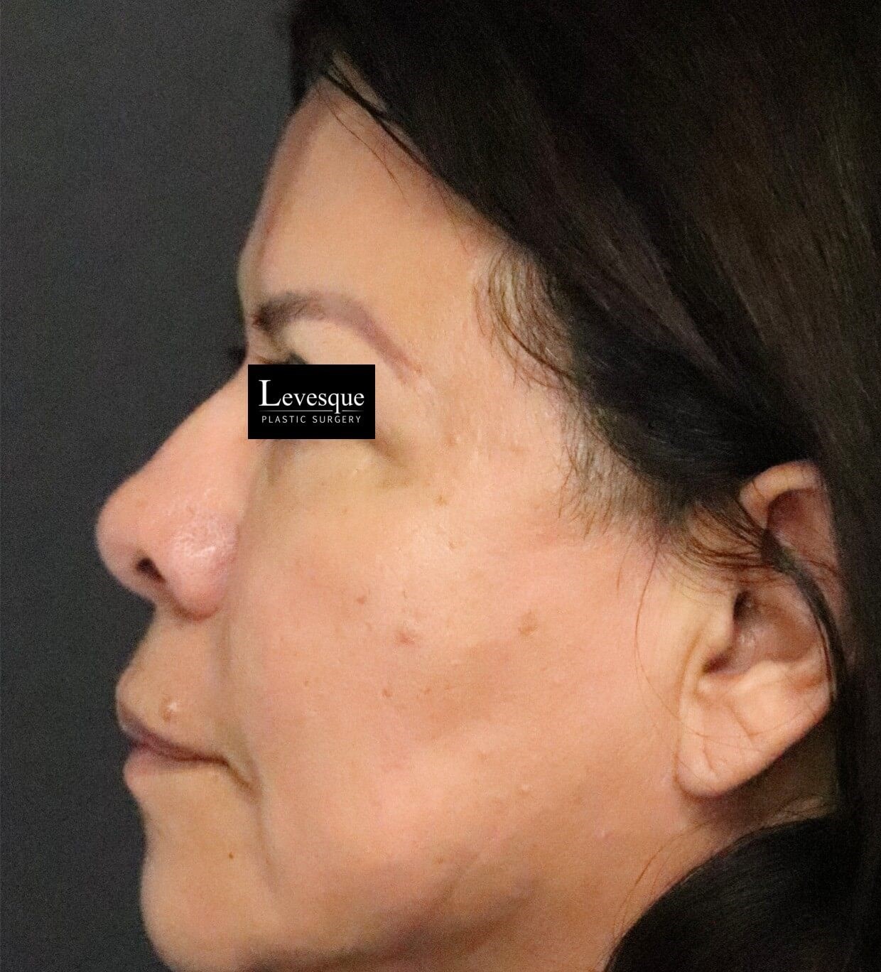 Hairline Browlift After