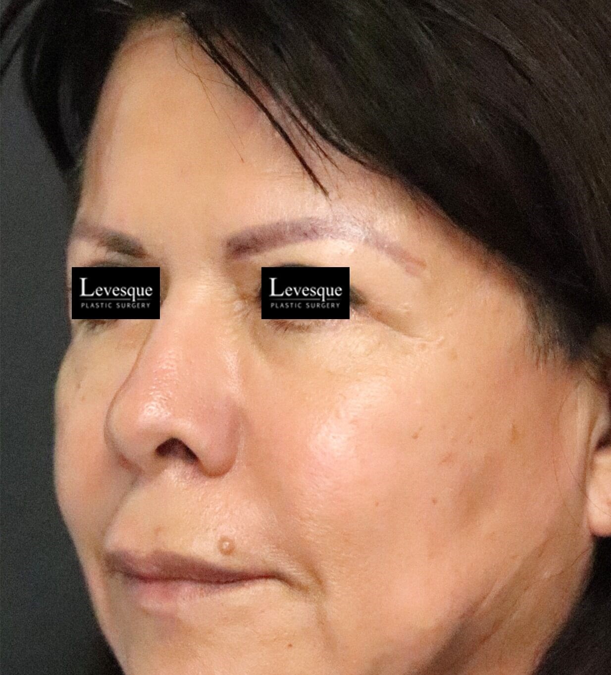 Hairline Browlift After