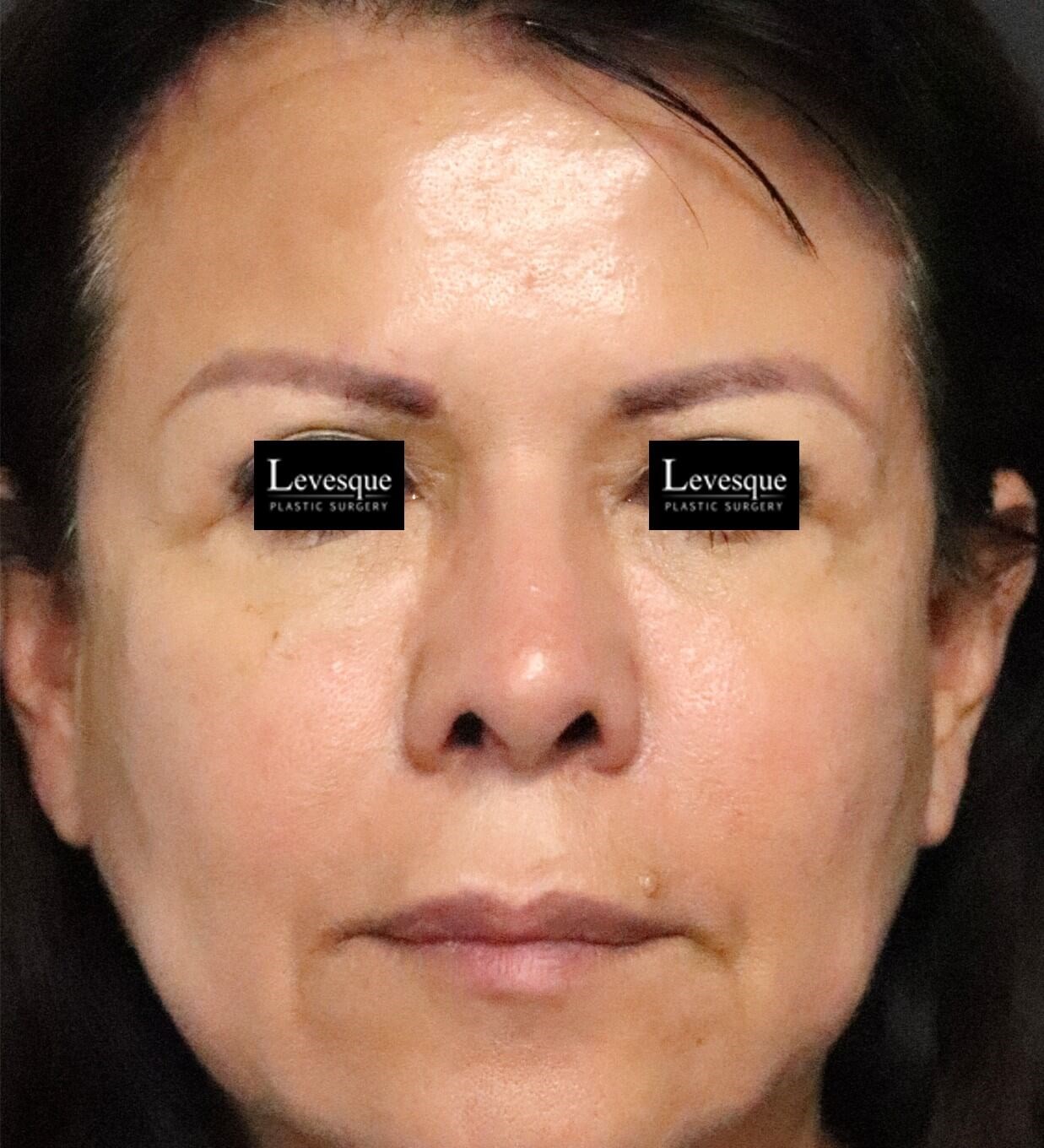 Hairline Browlift After