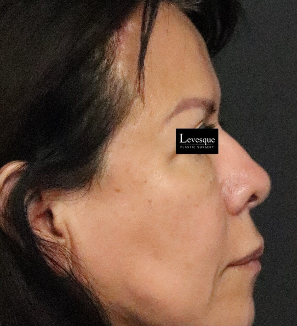 Hairline Browlift After