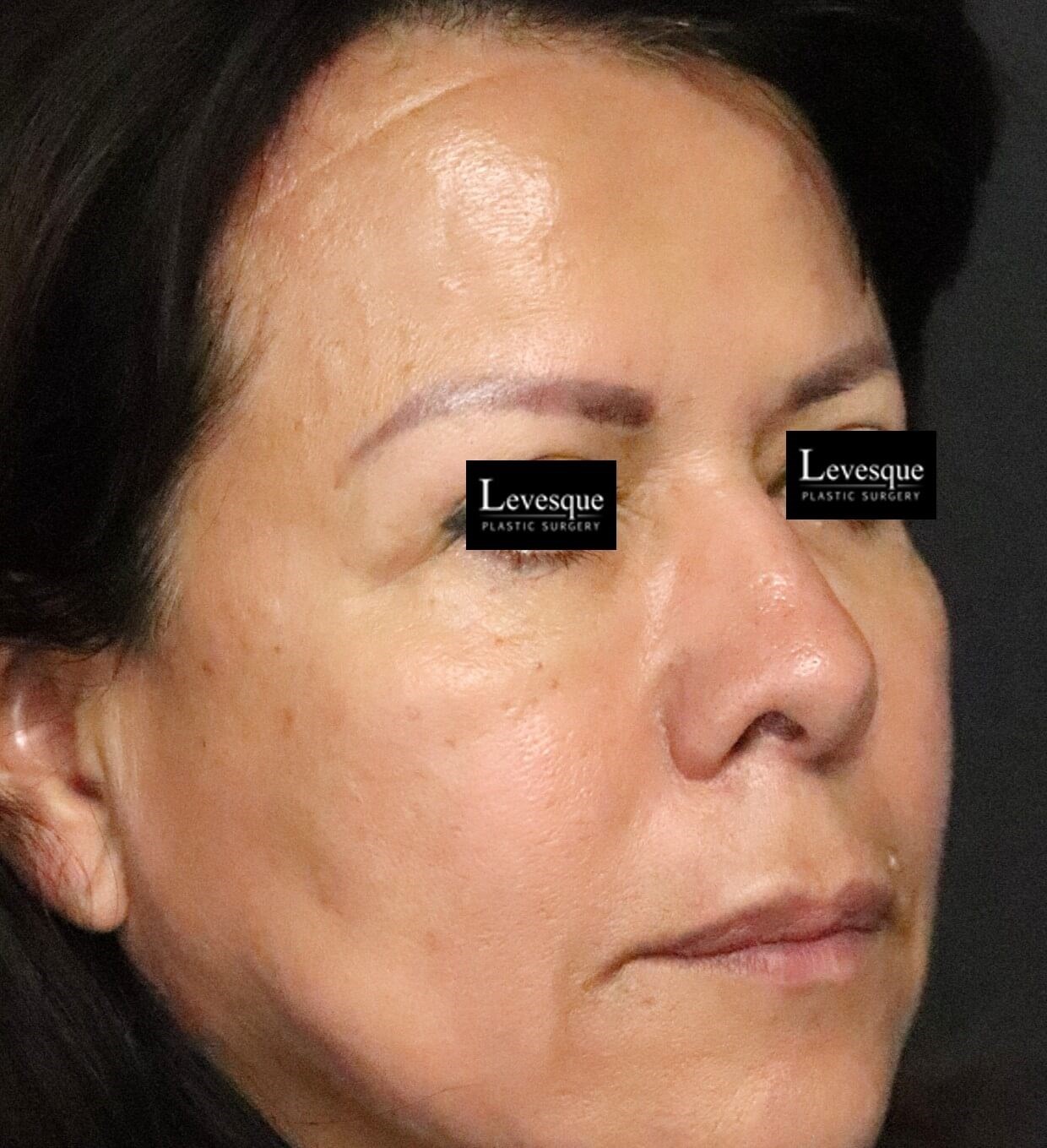 Hairline Browlift After