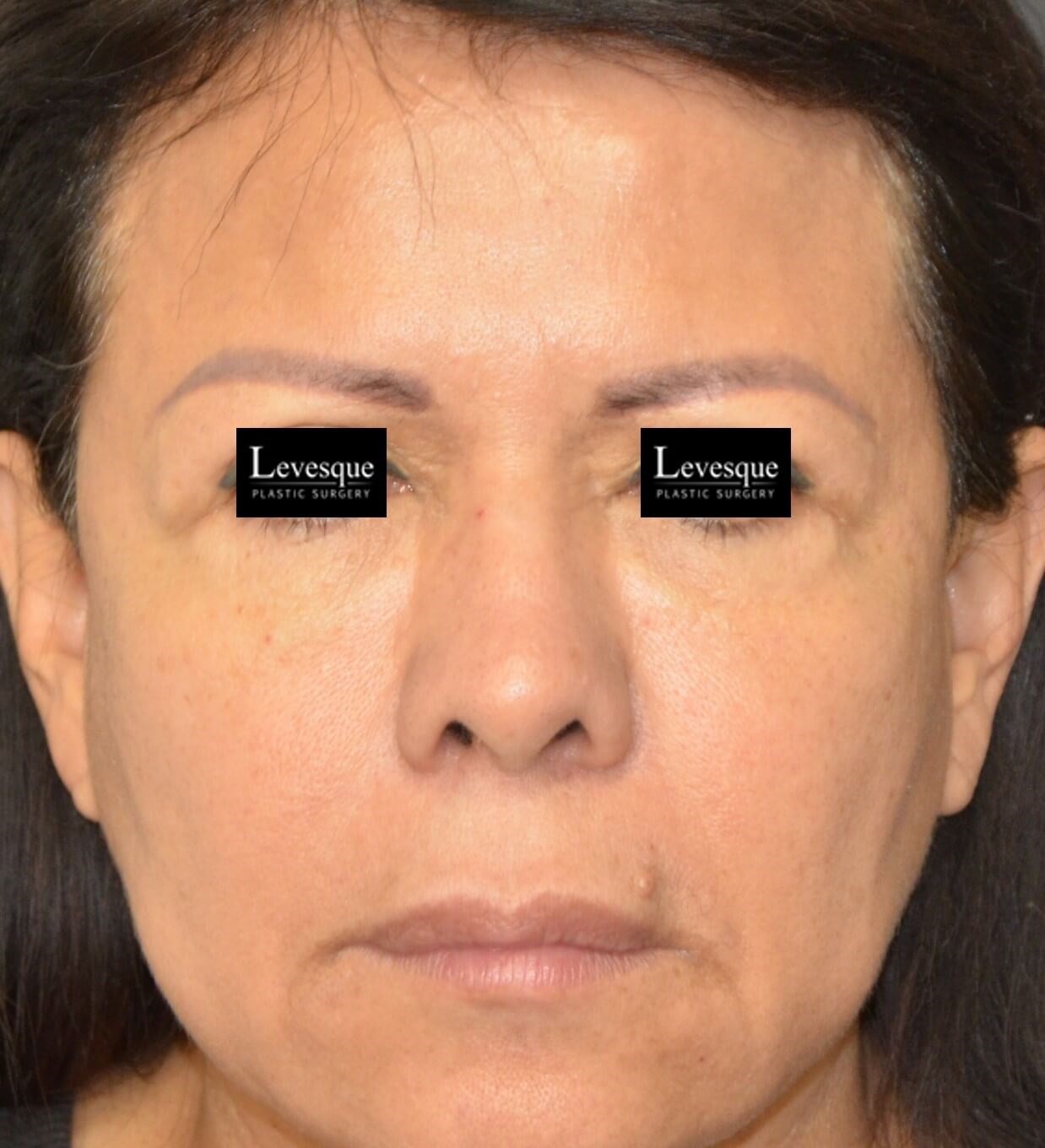 Hairline Browlift Before