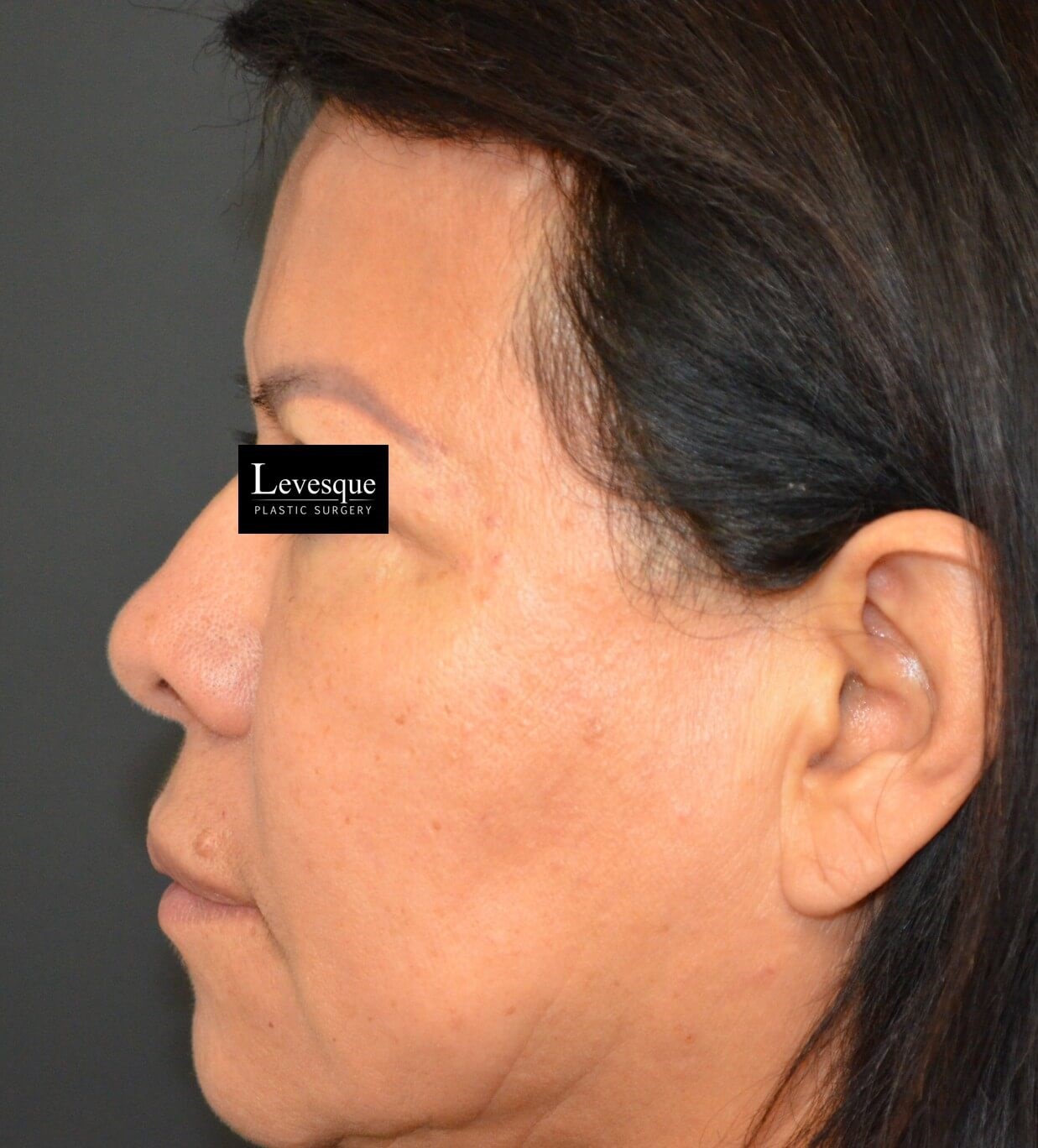 Hairline Browlift Before